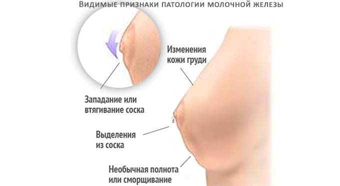 Какие симптомы характерны для аденоза видимые признаки патологии молочной железы