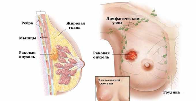Может ли боль быть признаком перерождения фиброаденомы в РМЖ Рак молочной железы - схема