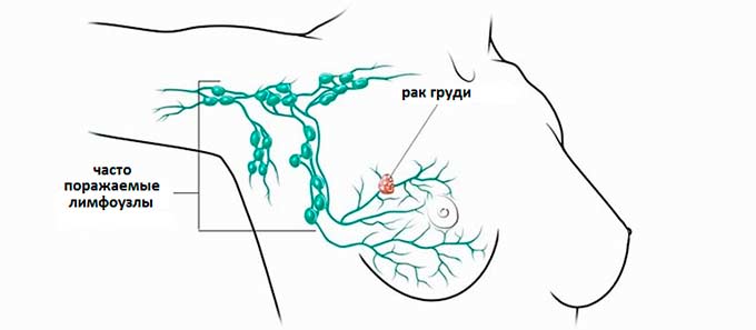 Опасность коллоидной формы рака Поражение лимфатических узлов при раке груди