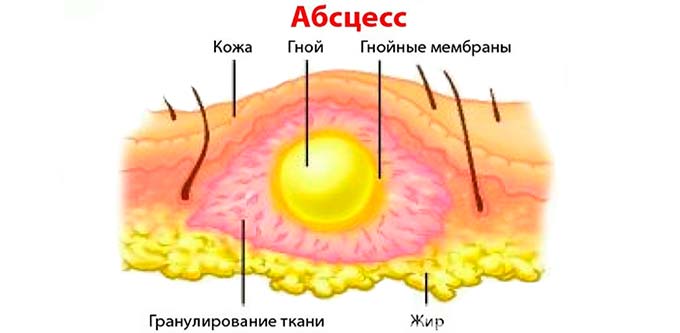 Какими последствиями опасна простуженная грудь Абсцесс