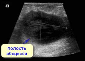 Область мастита на УЗИ