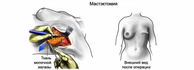 Хирургическое вмешательство Мастэктомия у женщин