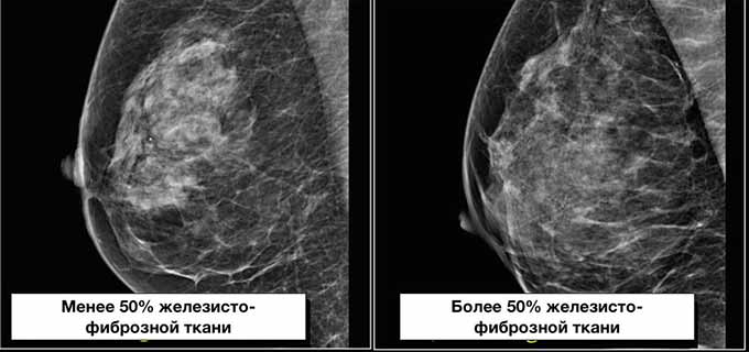 Диагностика патологического состояния УЗИ молочной железы