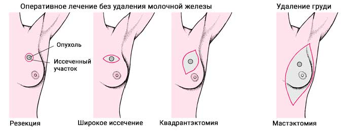 Лечение и поддерживающие методики в условиях стационара Виды операций по удалению опухоли в молочной железе