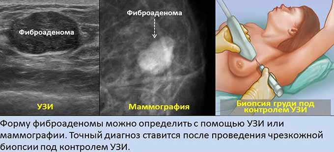 Малоинвазивные методы Диагностические методы при фиброаденоме