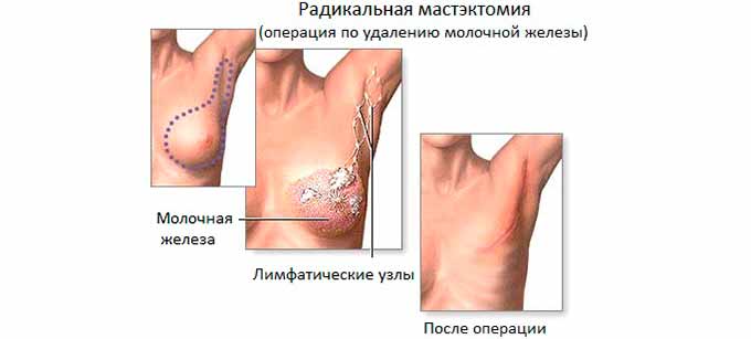 Оперативное вмешательство Радикальная мастэктомия