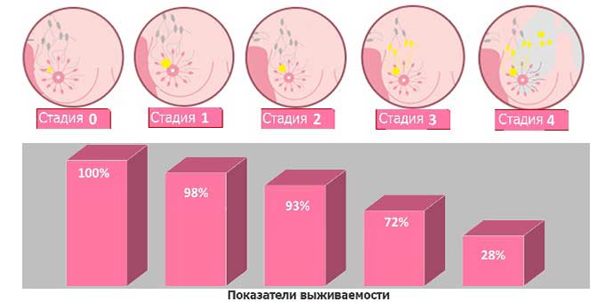 Прогноз на выживаемость Процент выживаемости при разных стадиях рака груди