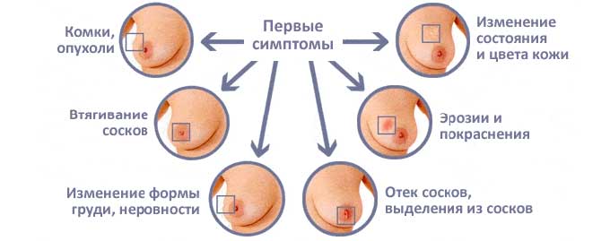 Симптомы заболеваний молочных желез