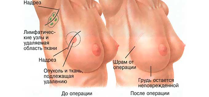 Выполнение операции техника выполнения лампэктомии