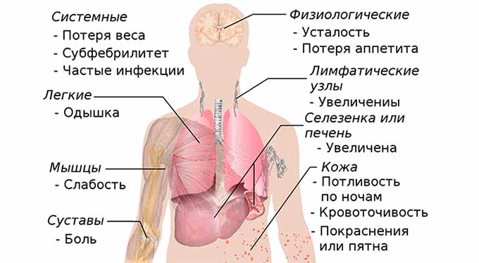 Распространение болевого дискомфорта при метастазах Симптомы распространения метастазов при раке