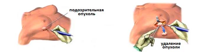 Особенности лечения болезни Хирургическое удаление образования в груди