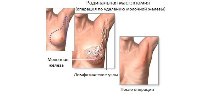 Хирургическое лечение Полное иссечение груди при РМЖ