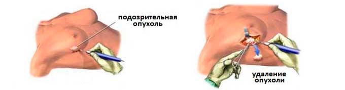 Проведение хирургического вмешательства Хирургическое удаление опухоли в груди
