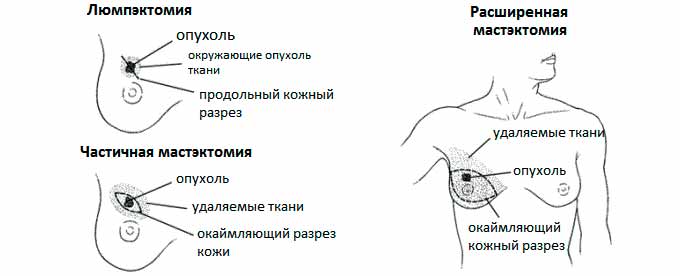 Радикальное лечение Лампэктомия м мастэктомия