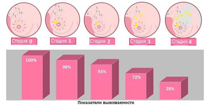 Предполагаемый прогноз и выживаемость Прогноз на выживаемость при раке груди