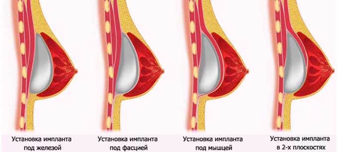 Хирургическое лечение Варианты увеличения груди с помощью имплантов