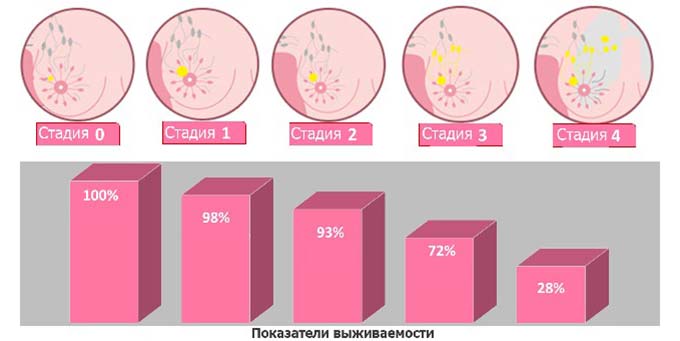 Возможные осложнения Выживаемость при разных стадиях рака груди