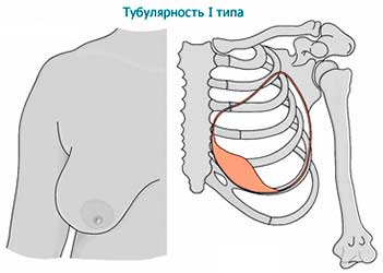 Тубулярность 1 типа