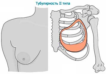 Тубулярность 2 типа