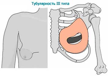 Тубулярность 3 типа
