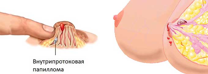 внутрипротоковая папиллома