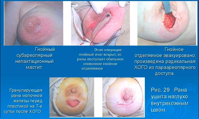 Кардинальное хирургическое вмешательство Хирургическое вскрытие гнойного мастита