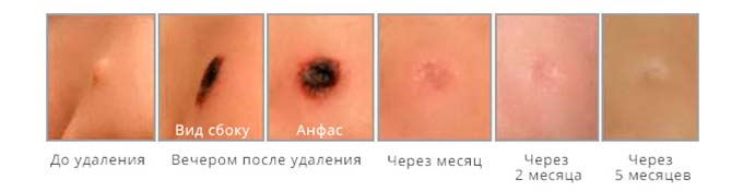 Криодеструкция результат удаления папилломы азотом
