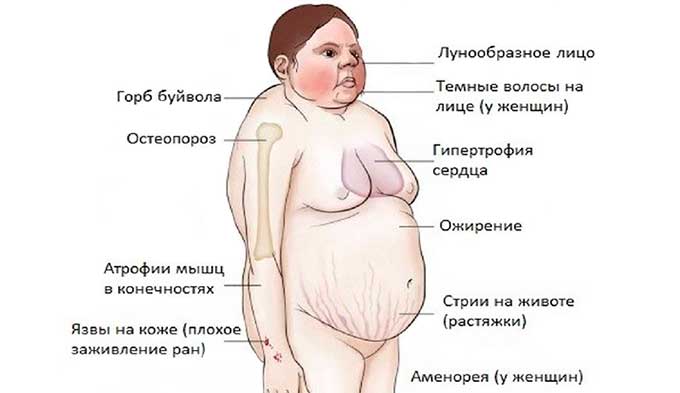 Синдром Кушинга Синдром Кушинга